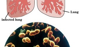 Penyakit Pernafasan Pneumonia